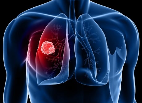 Lung Cancer Screening Claremore